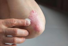 Cum recunoști primele semne ale psoriazisului și ce măsuri poți lua?