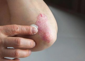 Cum recunoști primele semne ale psoriazisului și ce măsuri poți lua?